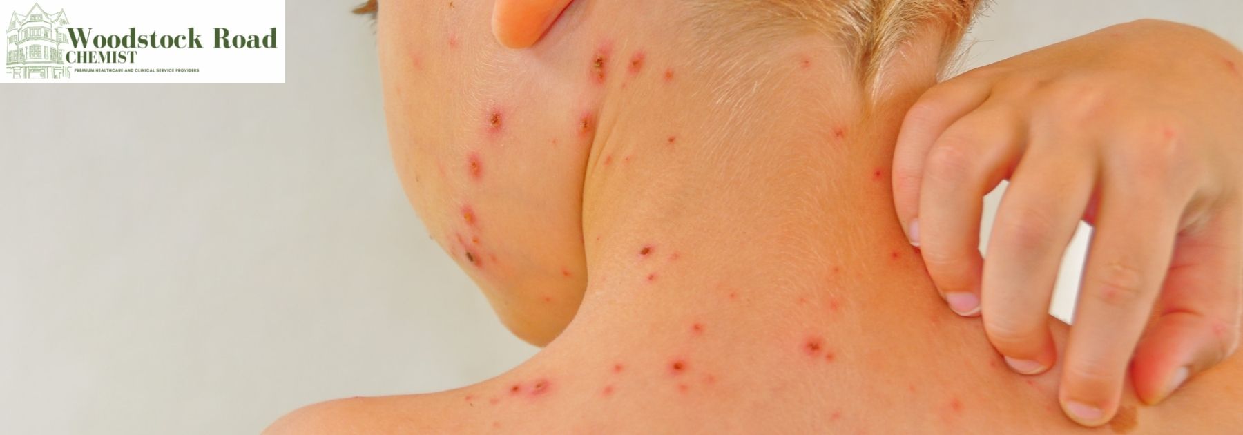 chickenpox
